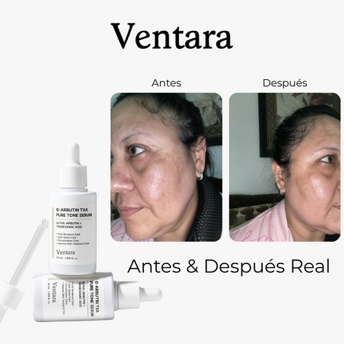 Ventara™ Serum de ACNE + Hiperpigmentación